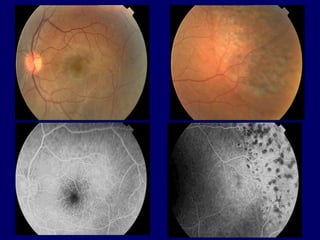 RETINOSCHISIS AND RETINAL DETACHMENT | PPT