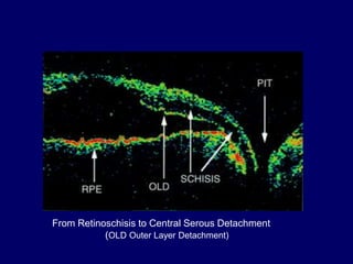 RETINOSCHISIS AND RETINAL DETACHMENT | PPT