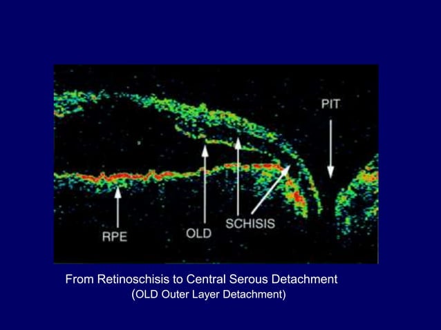 RETINOSCHISIS AND RETINAL DETACHMENT | PPT | Eye and Vision Conditions ...