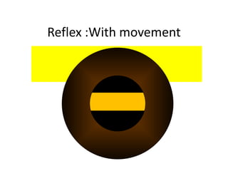 Reflex :With movement
 