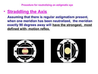 • Straddling the Axis
Assuming that there is regular astigmatism present,
when one meridian has been neutralized, the meridian
exactly 90 degrees away will have the strongest, most
defined with- motion reflex.
Procedure for neutralizing an astigmatic eye
 
