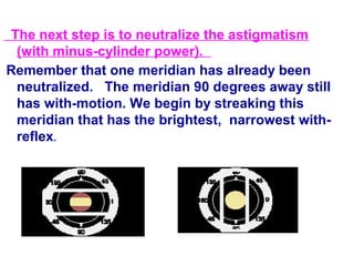 The next step is to neutralize the astigmatism
(with minus-cylinder power).
Remember that one meridian has already been
neutralized. The meridian 90 degrees away still
has with-motion. We begin by streaking this
meridian that has the brightest, narrowest with-
reflex.
 