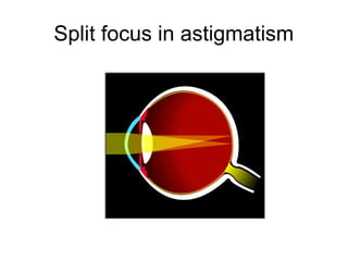 Split focus in astigmatism
 