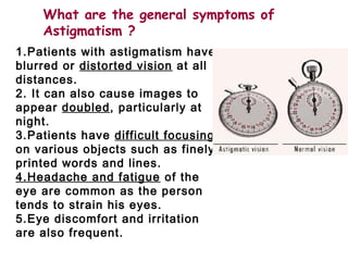 1.Patients with astigmatism have
blurred or distorted vision at all
distances.
2. It can also cause images to
appear doubled, particularly at
night.
3.Patients have difficult focusing
on various objects such as finely
printed words and lines.
4.Headache and fatigue of the
eye are common as the person
tends to strain his eyes.
5.Eye discomfort and irritation
are also frequent.
What are the general symptoms of
Astigmatism ?
 