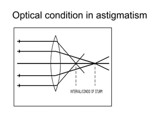 Optical condition in astigmatism
 