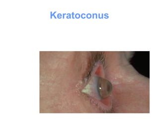 Keratoconus
 