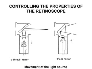 CONTROLLING THE PROPERTIES OF
THE RETINOSCOPE
Plane mirrorConcave mirror
Movement of the light source
 