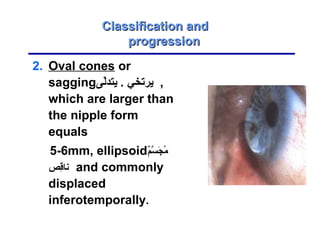 2. Oval cones or
sagging‫لى‬ّ‫ة‬‫يتد‬ . ‫يرتخي‬ ,
which are larger than
the nipple form
equals
5-6mm, ellipsoid‫م‬ٌ ‫ان‬‫س‬َّ‫م‬ ‫ج‬َ a ‫م‬ُ‫ض‬
‫ق ص‬ِ‫قي‬‫نا‬ and commonly
displaced
inferotemporally.
Classification andClassification and
progressionprogression
 