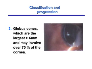 3. Globus cones,
which are the
largest  6mm
and may involve
over 75 % of the
cornea.
Classification andClassification and
progressionprogression
 