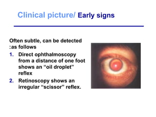 Often subtle, can be detected
as follows:
1. Direct ophthalmoscopy
from a distance of one foot
shows an “oil droplet”
reflex
2. Retinoscopy shows an
irregular “scissor” reflex.
Clinical picture/ Early signs
 