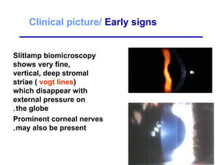 Clinical picture/ Early signs
Slitlamp biomicroscopy
shows very fine,
vertical, deep stromal
striae ( vogt lines)
which disappear with
external pressure on
the globe.
Prominent corneal nerves
may also be present.
 