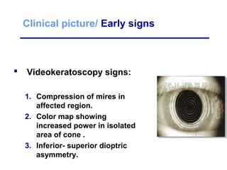  Videokeratoscopy signs:
1. Compression of mires in
affected region.
2. Color map showing
increased power in isolated
area of cone .
3. Inferior- superior dioptric
asymmetry.
Clinical picture/ Early signs
 