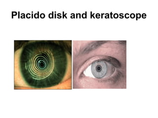 Placido disk and keratoscope
 