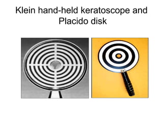 Klein hand-held keratoscope and
Placido disk
 