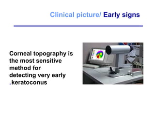 Clinical picture/ Early signs
Corneal topography is
the most sensitive
method for
detecting very early
keratoconus.
 