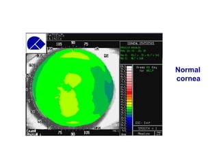 Normal
cornea
 
