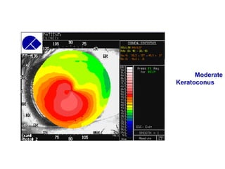 Moderate
Keratoconus
 