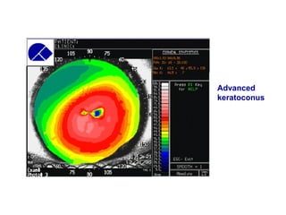 Advanced
keratoconus
 