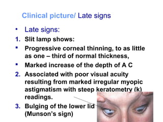 Clinical picture/ Late signs
• Late signs:
1. Slit lamp shows:
 Progressive corneal thinning, to as little
as one – third of normal thickness,
 Marked increase of the depth of A C
2. Associated with poor visual acuity
resulting from marked irregular myopic
astigmatism with steep keratometry (k)
readings.
3. Bulging of the lower lid in down gaze
(Munson’s sign)
 