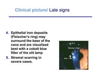 Clinical picture/ Late signs
4. Epithelial iron deposits
(Fleischer’s ring) may
surround the base of the
cone and are visualized
best with a cobalt blue
filter of the slit lamp
5. Stromal scarring in
severe cases.
 