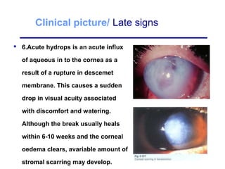Clinical picture/ Late signs
 6.Acute hydrops is an acute influx
of aqueous in to the cornea as a
result of a rupture in descemet
membrane. This causes a sudden
drop in visual acuity associated
with discomfort and watering.
Although the break usually heals
within 6-10 weeks and the corneal
oedema clears, avariable amount of
stromal scarring may develop.
 