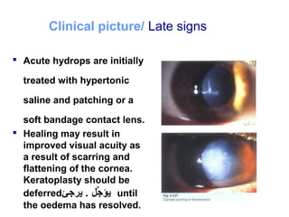 Clinical picture/ Late signs
 Acute hydrops are initially
treated with hypertonic
saline and patching or a
soft bandage contact lens.
 Healing may result in
improved visual acuity as
a result of scarring and
flattening of the cornea.
Keratoplasty should be
deferred‫يرجئ‬ . ‫جل‬ِّ ‫يؤ‬ until
the oedema has resolved.
 