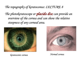 The topography of keratoconus: LECTURE 8The topography of keratoconus: LECTURE 8
The photokeratoscope orThe photokeratoscope or placido discplacido disc can provide ancan provide an
overview of the cornea and can show the relativeoverview of the cornea and can show the relative
steepness of any corneal area.steepness of any corneal area.
keratoconic corneakeratoconic cornea Normal corneaNormal cornea
 