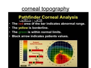 corneal topography
‫ش ف‬ِ‫ ف‬ ‫ك‬ْ‫ِش‬ ‫ت‬َ‫ْك‬‫س‬ْ‫ِش‬ ‫م‬ُ‫س‬ ; ‫ فاف‬‫ش‬َّ‫ا‬ ‫ك‬َ‫ْك‬
 