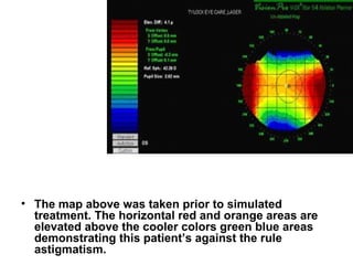 • The map above was taken prior to simulated
treatment. The horizontal red and orange areas are
elevated above the cooler colors green blue areas
demonstrating this patient’s against the rule
astigmatism.
 