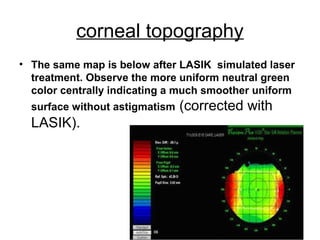 corneal topography
• The same map is below after LASIK simulated laser
treatment. Observe the more uniform neutral green
color centrally indicating a much smoother uniform
surface without astigmatism (corrected with
LASIK).
 