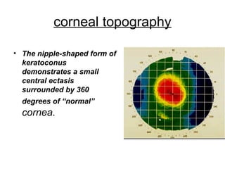 corneal topography
• The nipple-shaped form of
keratoconus
demonstrates a small
central ectasis
surrounded by 360
degrees of “normal”
cornea.
 