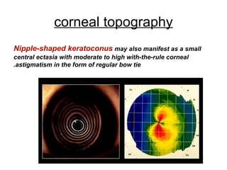corneal topography
Nipple-shaped keratoconus may also manifest as a small
central ectasia with moderate to high with-the-rule corneal
astigmatism in the form of regular bow tie.
 