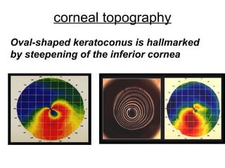 corneal topography
Oval-shaped keratoconus is hallmarked
by steepening of the inferior cornea
 
