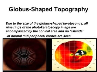 Globus-Shaped Topography
Due to the size of the globus-shaped keratoconus, all
nine rings of the photokeratoscopy image are
encompassed by the conical area and no “islands”
of normal mid-peripheral cornea are seen.
 