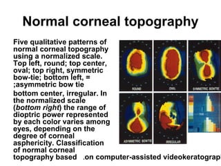 Normal corneal topography
Five qualitative patterns of
normal corneal topography
using a normalized scale.
Top left, round; top center,
oval; top right, symmetric
bow-tie; bottom left, =
asymmetric bow tie;
bottom center, irregular. In
the normalized scale
(bottom right( the range of
dioptric power represented
by each color varies among
eyes, depending on the
degree of corneal
asphericity. Classification
of normal corneal
topography based on computer-assisted videokeratograph.
 