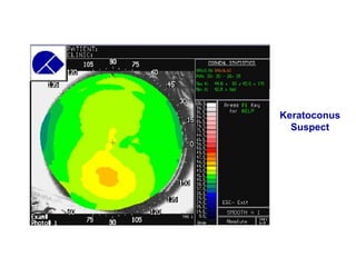 Keratoconus
Suspect
 