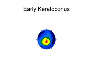 Early Keratoconus
 