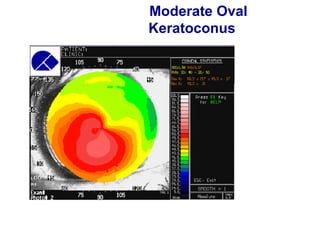 Moderate Oval
Keratoconus
 