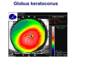 Globus keratoconus
 