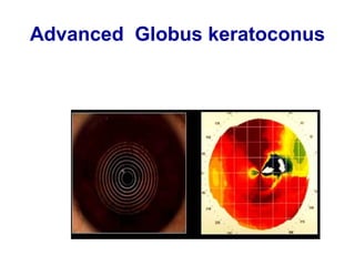 Advanced Globus keratoconus
 