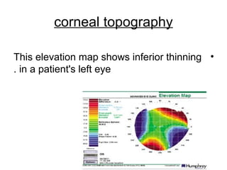 corneal topography
•This elevation map shows inferior thinning
in a patient's left eye.
 