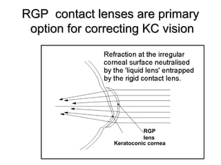 RGP contact lenses are primaryRGP contact lenses are primary
option for correcting KC visionoption for correcting KC vision
Keratoconic cornea
RGP
lens
 