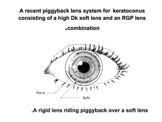 A recent piggyback lens system forA recent piggyback lens system for keratoconuskeratoconus
consisting of a high Dk soft lens and an RGP lensconsisting of a high Dk soft lens and an RGP lens
combinationcombination..
A rigid lens riding piggyback over a soft lens.
 
