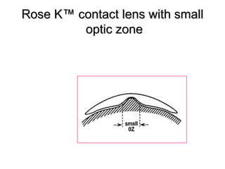Rose K™Rose K™ contact lens with smallcontact lens with small
optic zoneoptic zone
 