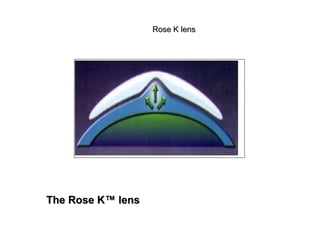 The Rose K™ lensThe Rose K™ lens
Rose K lensRose K lens
 