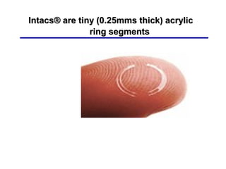 Intacs® are tiny (0.25mms thick( acrylicIntacs® are tiny (0.25mms thick( acrylic
ring segmentsring segments
 