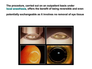 The procedure, carried out on an outpatient basis underThe procedure, carried out on an outpatient basis under
local anesthesialocal anesthesia, offers the benefit of being reversible and even, offers the benefit of being reversible and even
potentially exchangeable as it involves no removal of eye tissuepotentially exchangeable as it involves no removal of eye tissue
 
