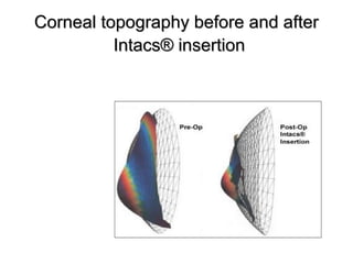 Corneal topography before and afterCorneal topography before and after
Intacs® insertionIntacs® insertion
 