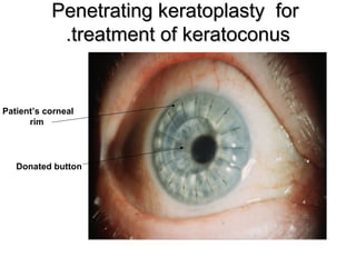 Penetrating keratoplasty forPenetrating keratoplasty for
treatment of keratoconustreatment of keratoconus..
Donated button
Patient’s corneal
rim
 
