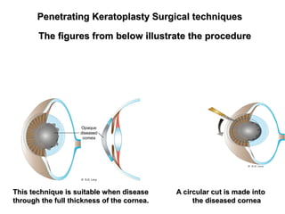 Penetrating Keratoplasty Surgical techniquesPenetrating Keratoplasty Surgical techniques
The figures from below illustrate the procedureThe figures from below illustrate the procedure
This technique is suitable when disease A circular cut is made intoThis technique is suitable when disease A circular cut is made into
through the full thickness of the cornea. the diseased corneathrough the full thickness of the cornea. the diseased cornea
 